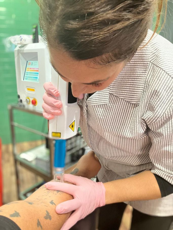 Una mujer está usando una máquina para eliminar un tatuaje del brazo de una persona.