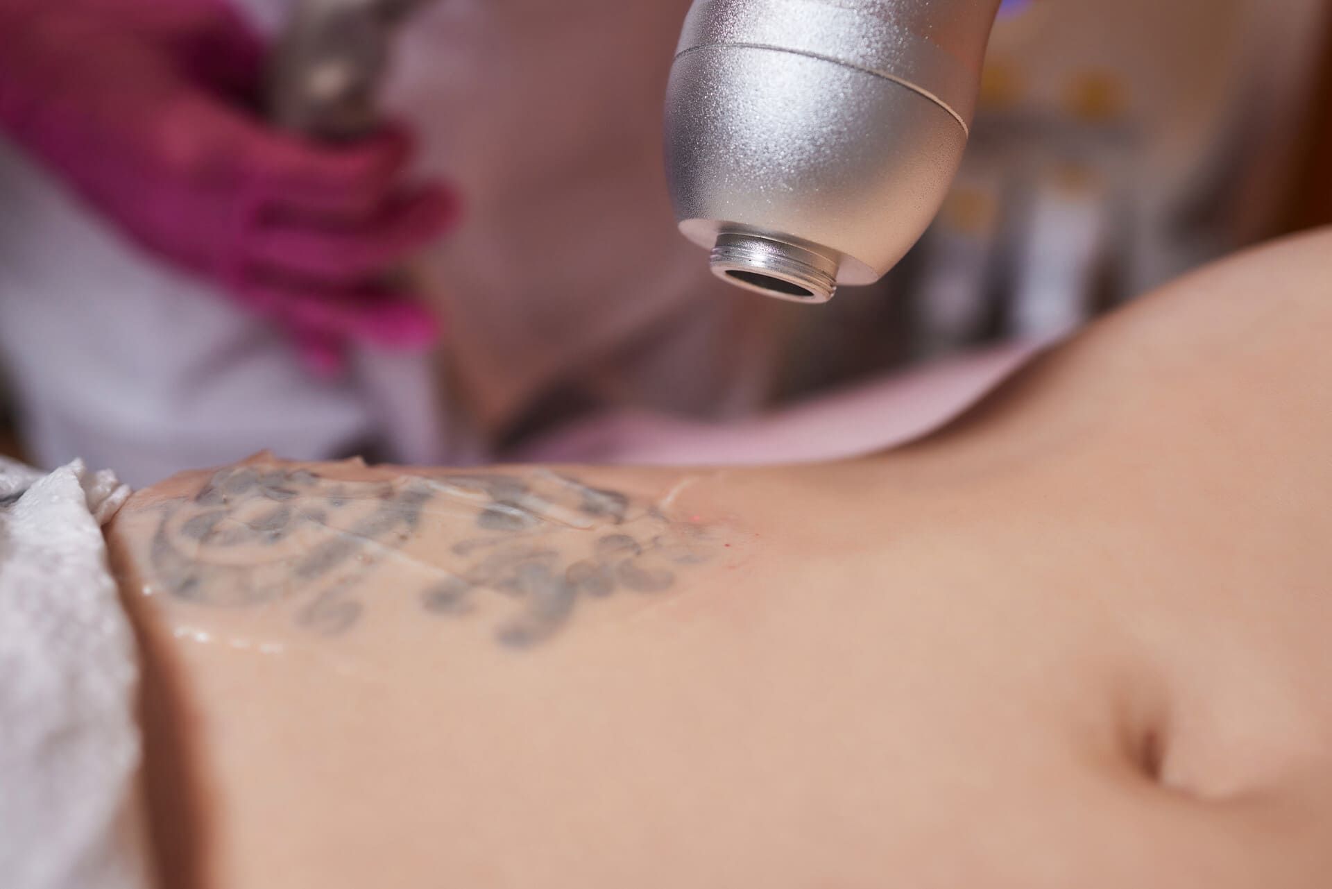 Una mujer se está eliminando un tatuaje del estómago.