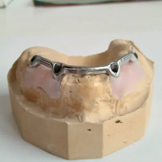Un modelo de una boca con un aparato de metal.
