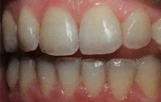 Un primer plano de los dientes de una persona con dientes blancos.