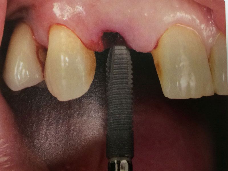 Un primer plano de la boca de una persona con un implante dental en ella.