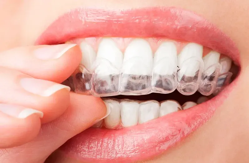 Una mujer se está colocando un aparato transparente en los dientes.