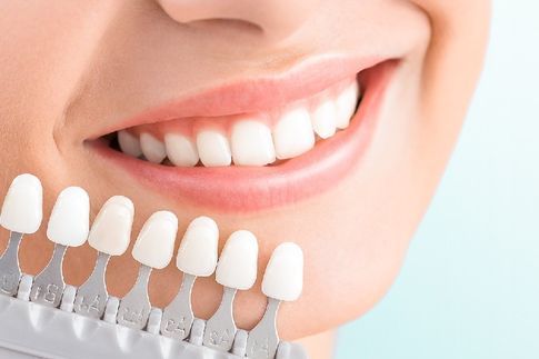 Zahnhelligkeit einer Patientin wird verglichen mit einer Behandlungsraum beim Zahnarzt