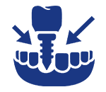 Grafik für Gebiss, in das ein Zahnimplantat eingebracht wird