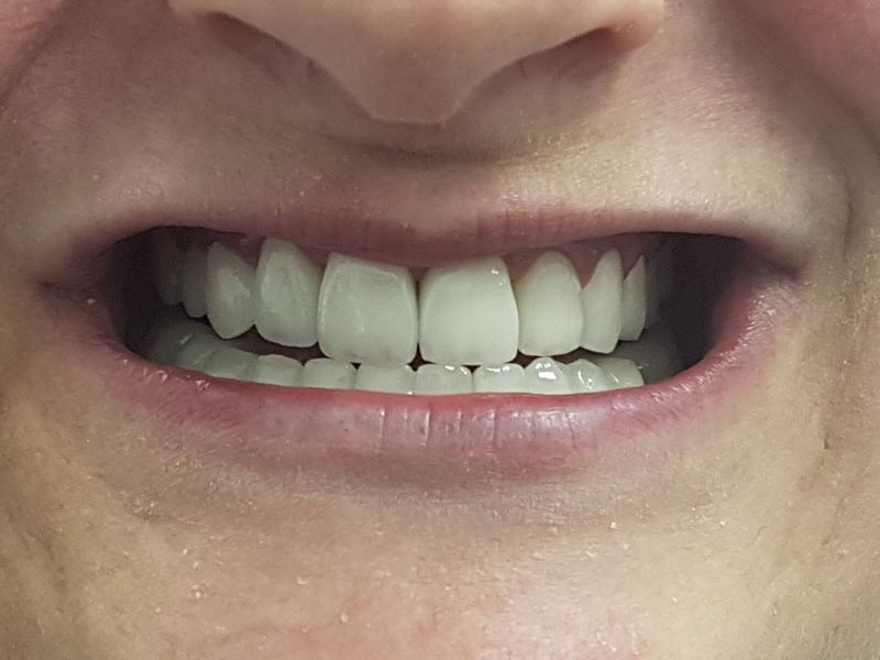 Un primer plano de la boca de una persona con dientes blancos.
