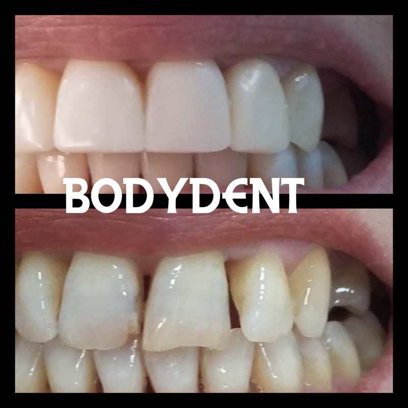 Una fotografía de antes y después de los dientes de una persona con las palabras body dent en la parte inferior.