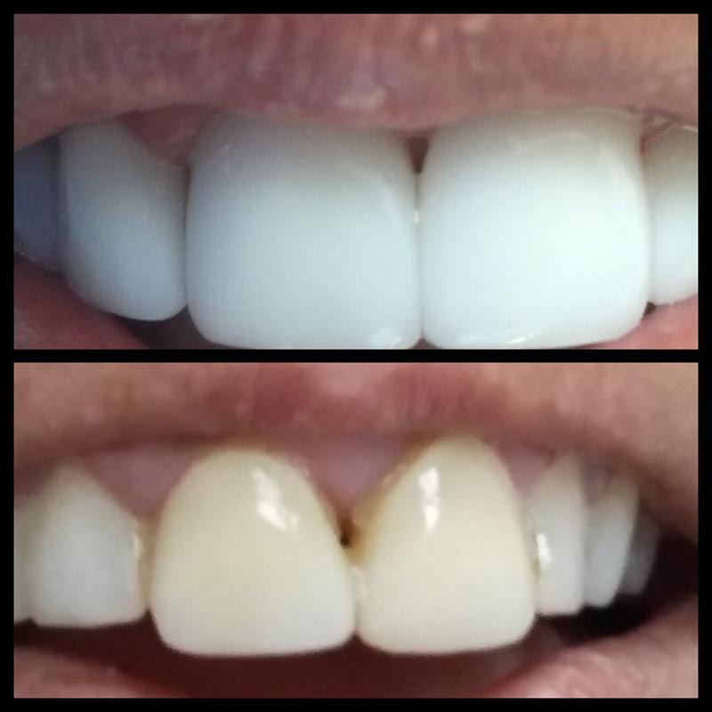 Una fotografía de antes y después de los dientes de una persona.
