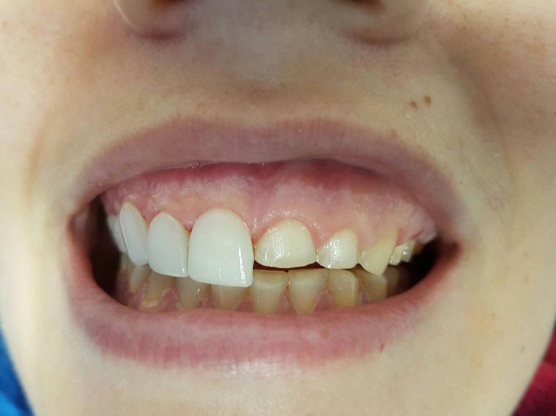Un primer plano de los dientes de una persona a la que le falta un diente.