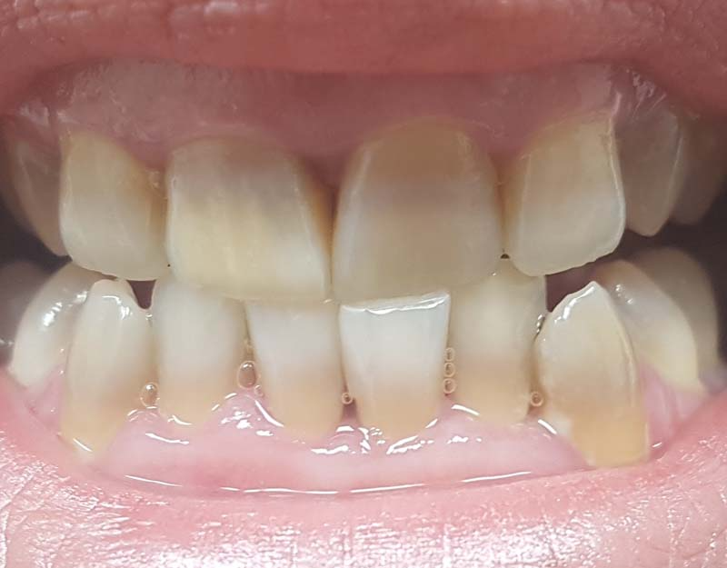 Un primer plano de los dientes de una persona con manchas amarillas.