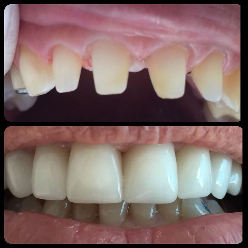 Una fotografía de antes y después de los dientes de una persona.