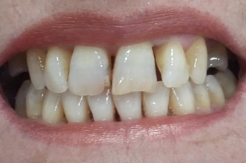 Un primer plano de los dientes de una persona con un diente roto.