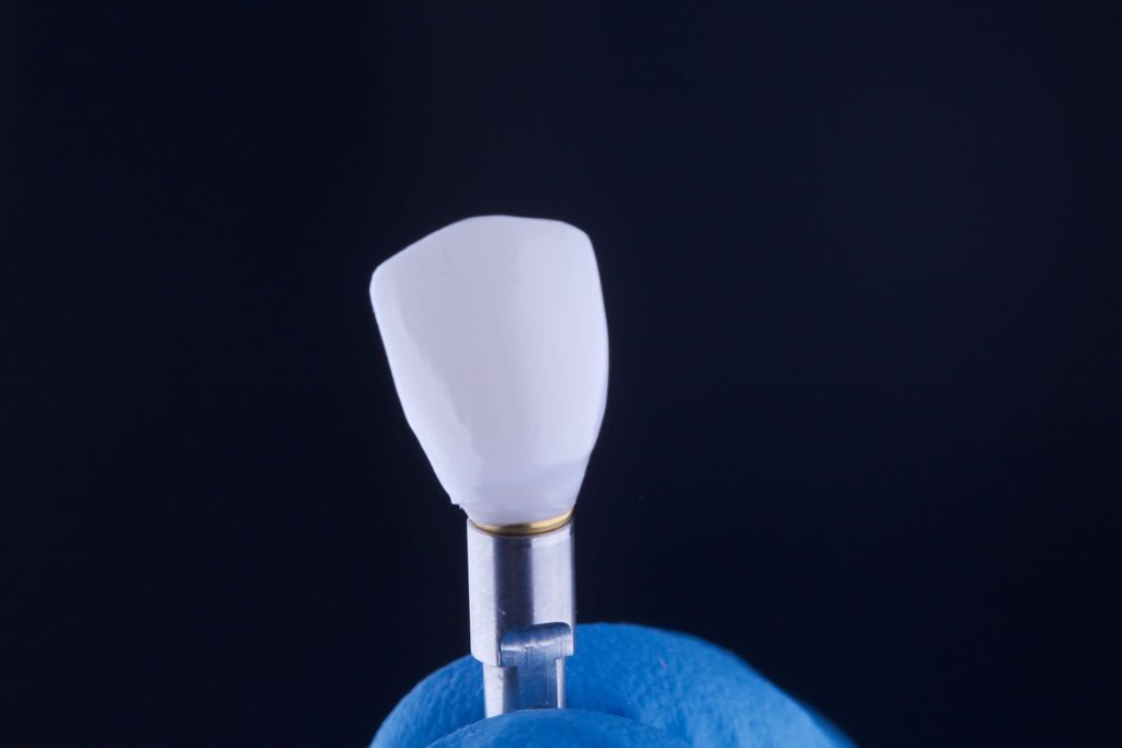 Una persona que lleva un guante azul sostiene una corona dental en su mano.