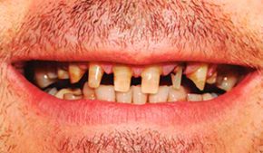 Un primer plano de la boca de un hombre con barba y dientes faltantes.