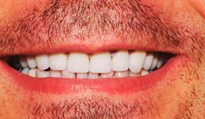 Un primer plano de la boca de un hombre con barba y dientes blancos.