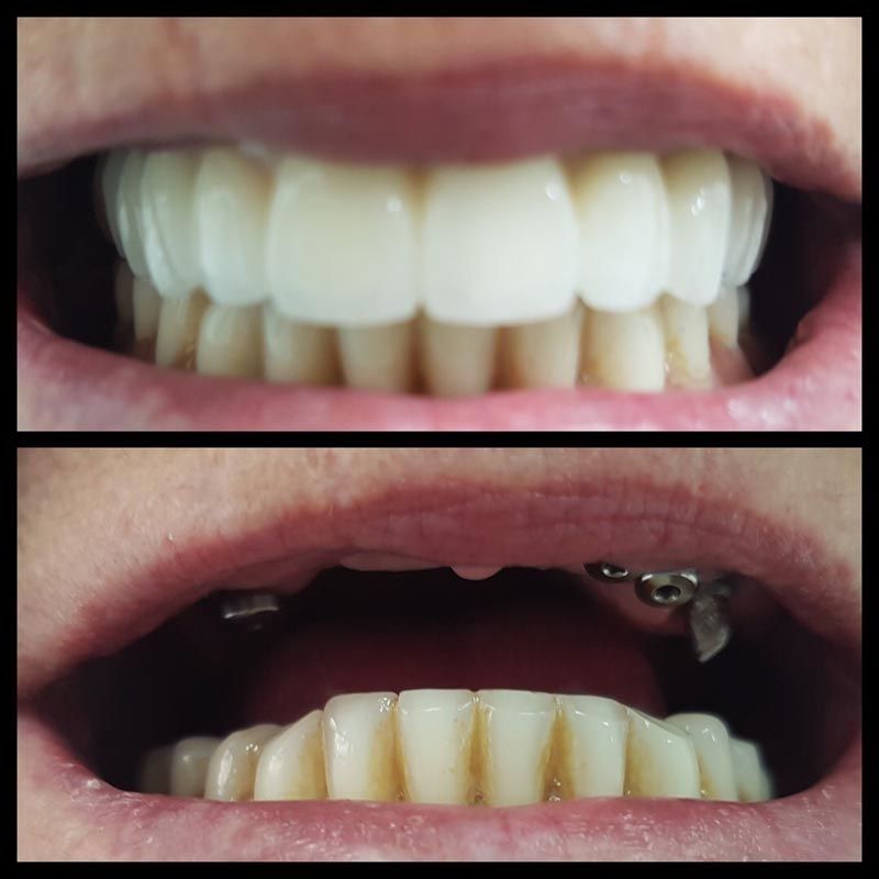 Una fotografía de antes y después de los dientes de una persona.