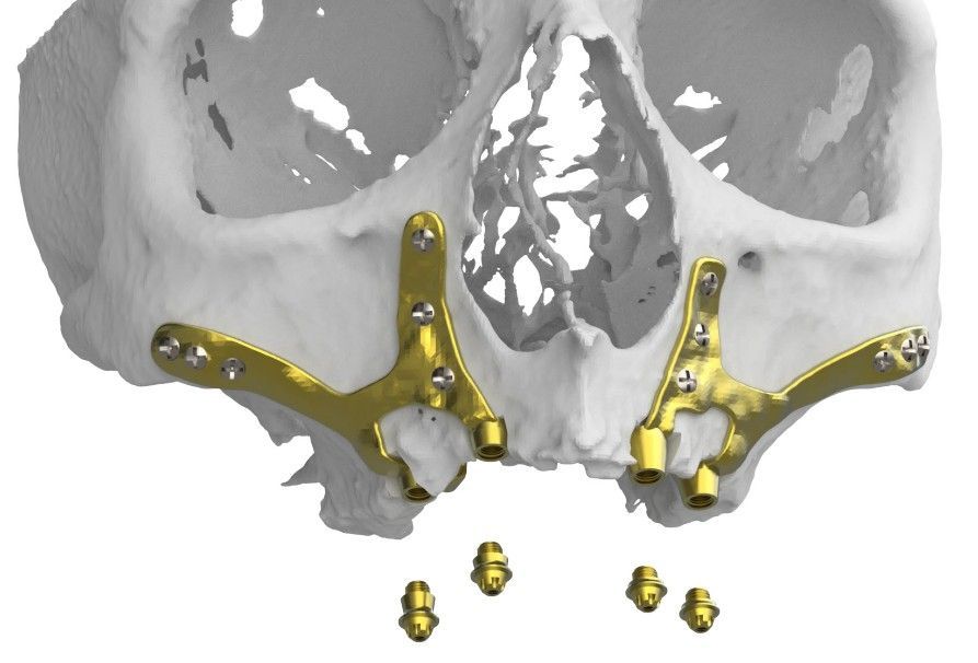 Dos implantes dentales están colocados uno encima del otro sobre una superficie azul.
