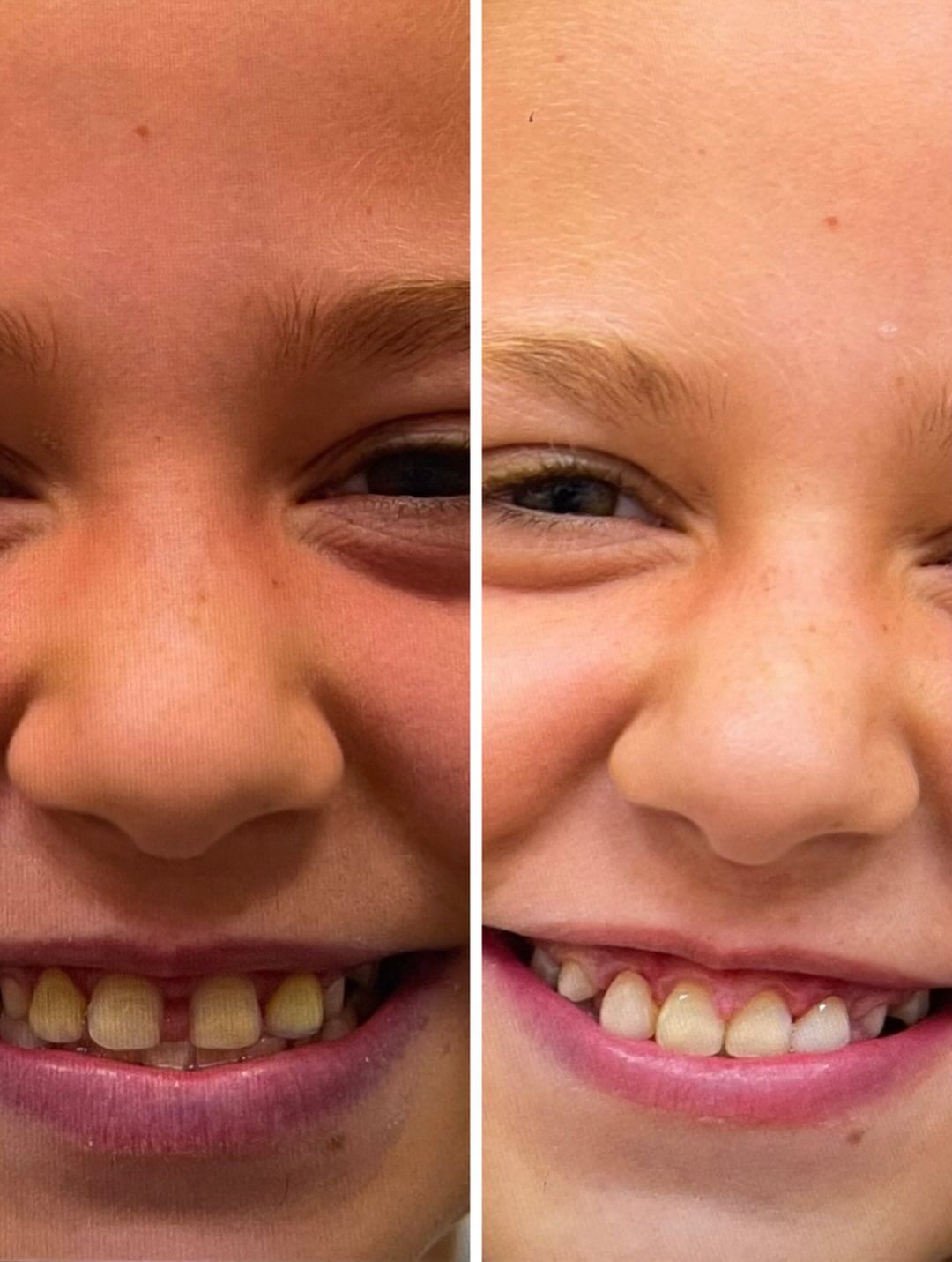 Una niña se está haciendo examinar los dientes por un dentista