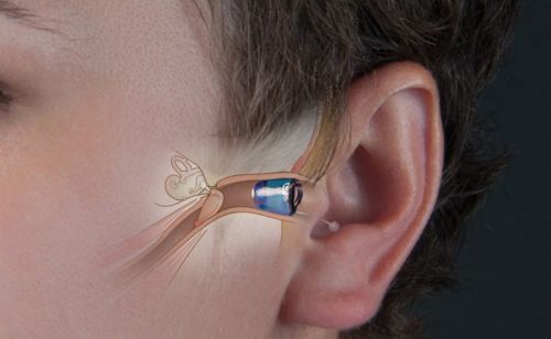 L'intraprofond (IIC = Invisible In Canal).