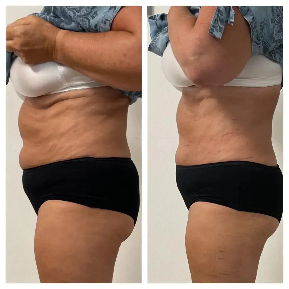 Vorher-Nachher-Frauenkörper von der Seite, Fitness Hempel