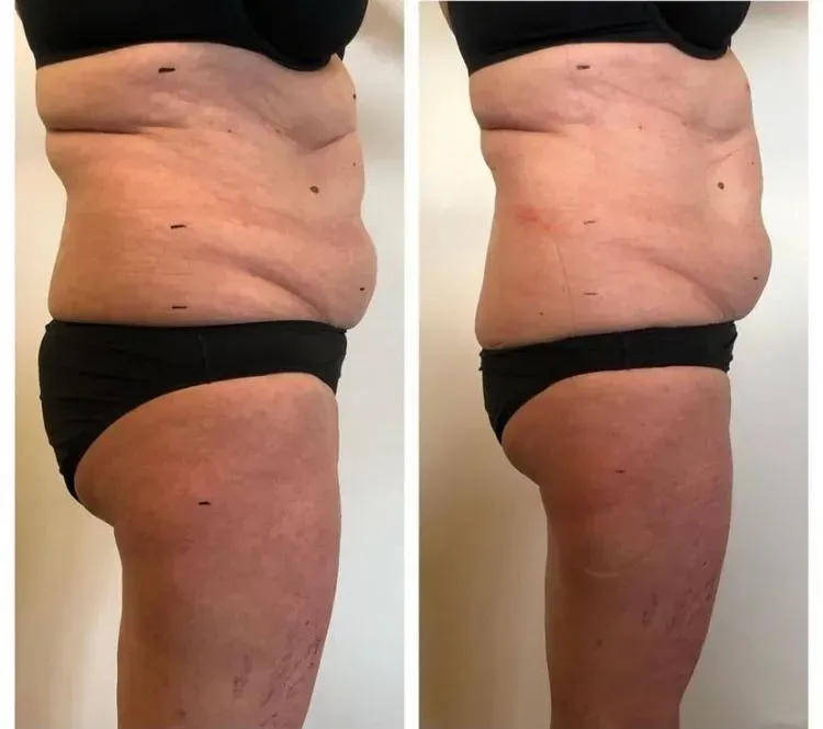 Vorher-Nachher-Frauenkörper von der Seite, Fitness Hempel