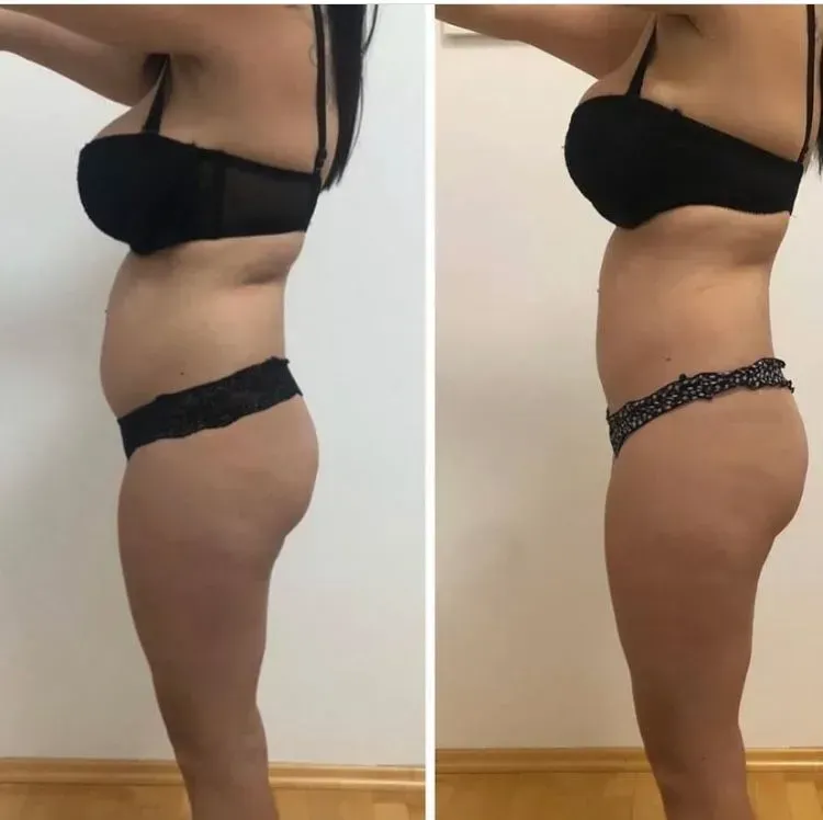 Vorher-Nachher-Frauenkörper von der Seite, Fitness Hempel