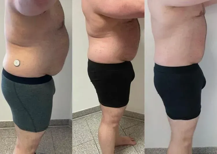 Vorher-Nachher-Männerkörper von der Seite, Fitness Hempel