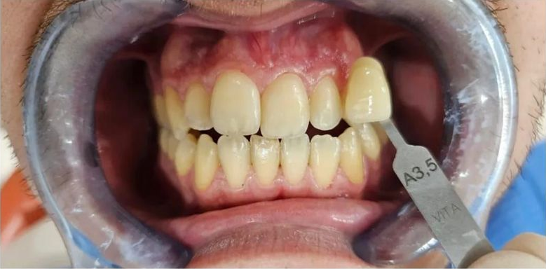 Primer plano de dientes que están siendo coloreados por un dentista, utilizando una guía de tonos denominada A3.5.