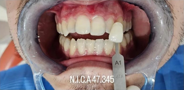 Paciente dental con la boca abierta. Se coloca una guía de colores delante de sus dientes.