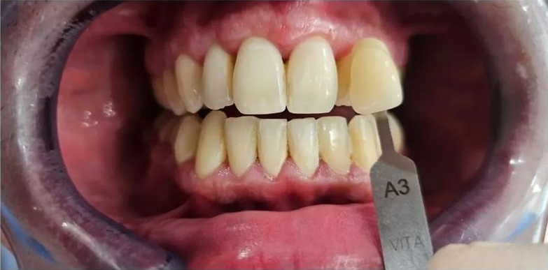 Boca abierta, dientes visibles. Un dentista usa una guía de colores para determinar el color de un diente. La guía indica A3.