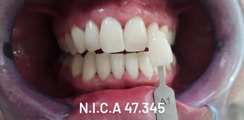 Un dentista comparando el tono de color de diente A1 con los dientes del paciente.