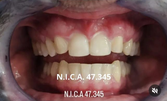 Primer plano de una boca, mostrando dientes y encías. Los dientes presentan una mezcla de blanco y amarillo.