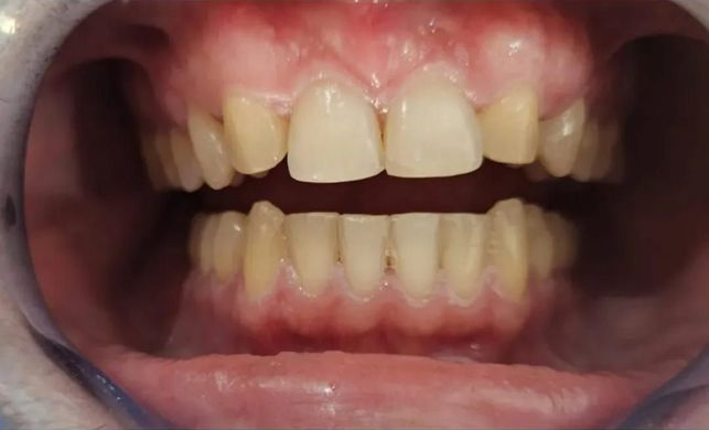 Vista de los dientes con la boca abierta, mostrando coloración amarillenta y cierta desalineación, con encías rosadas.