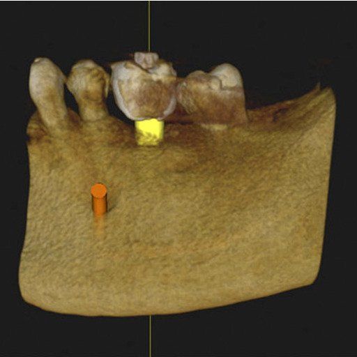 Representación 3D de una mandíbula con dos implantes: uno dorado y otro naranja.
