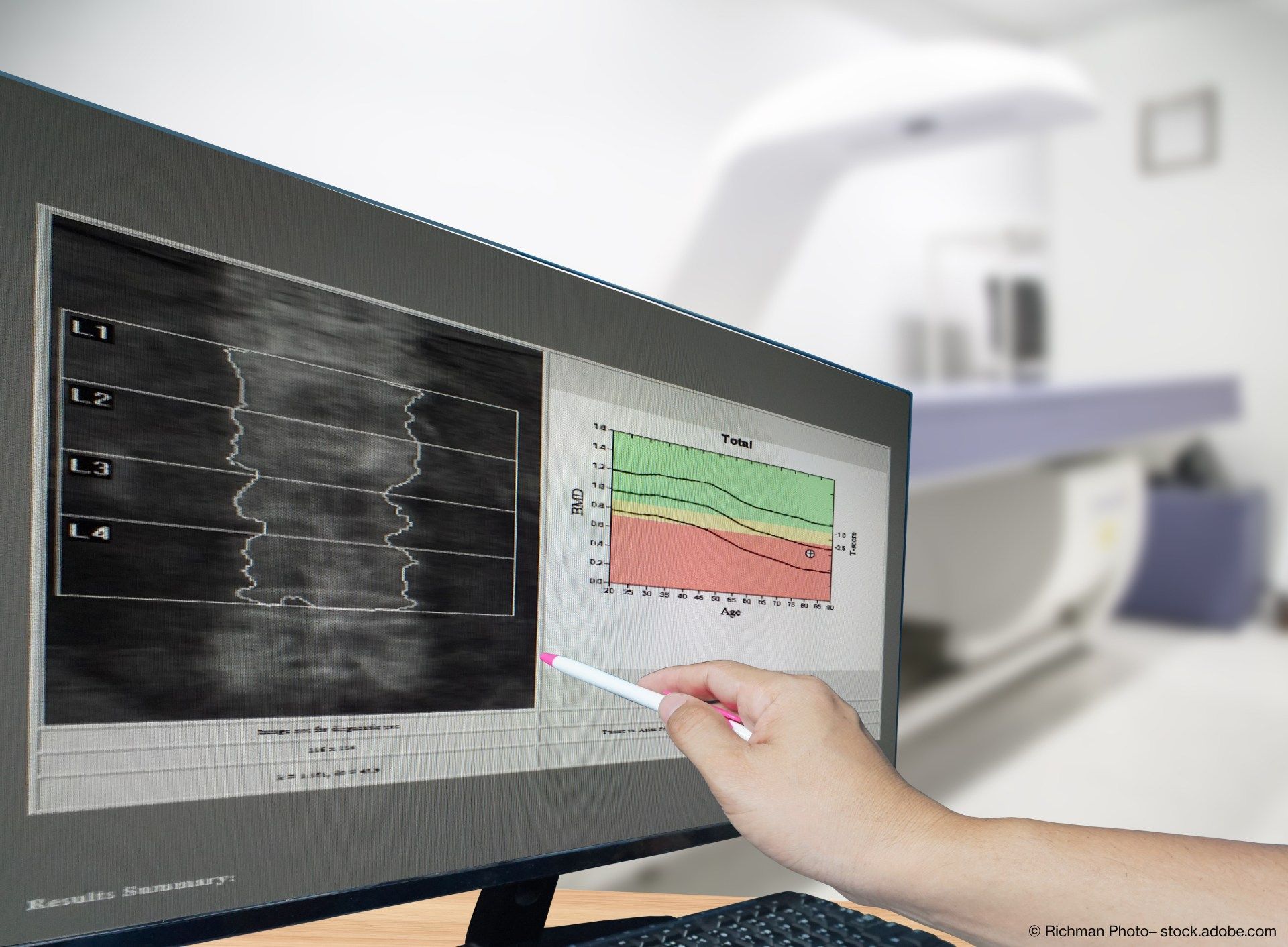 Arzt zeigt seinem Patienten am Computer die Ergebnisse der Knochendichtemessung