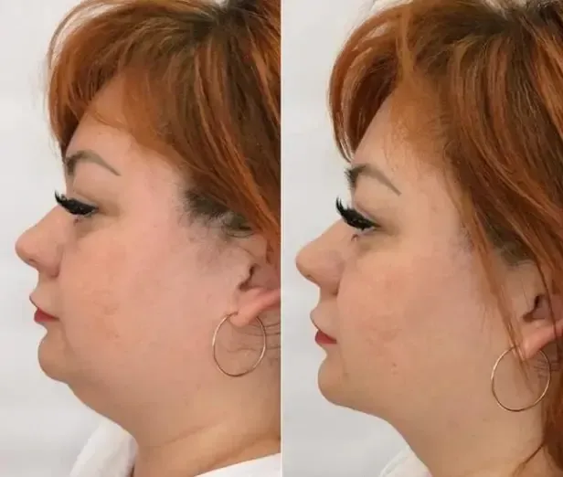 Durante un tratamiento de spa, un profesional utiliza un dispositivo cosmético manual en la frente de una persona.