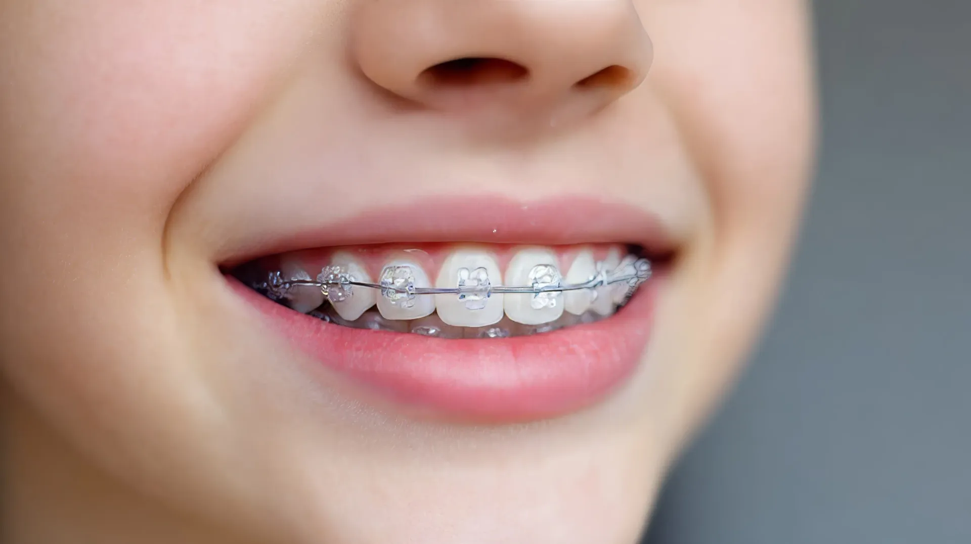 Primer plano de la boca sonriente de una persona con aparatos plateados en los dientes.