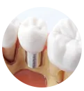 Un primer plano de un diente con un implante dental.