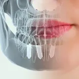 Una radiografía de la boca y los dientes de una mujer con implantes dentales.