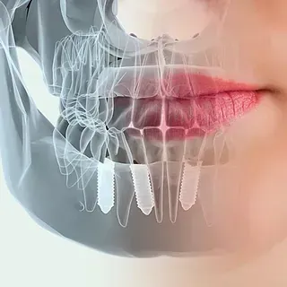 Una radiografía de la boca y los dientes de una mujer con implantes dentales.