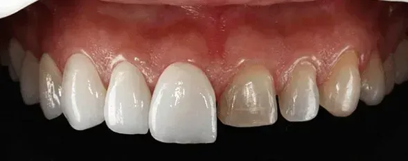 Un primer plano de los dientes de una persona con un fondo negro.