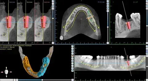 Una pantalla de computadora muestra una radiografía dental de los dientes de una persona.