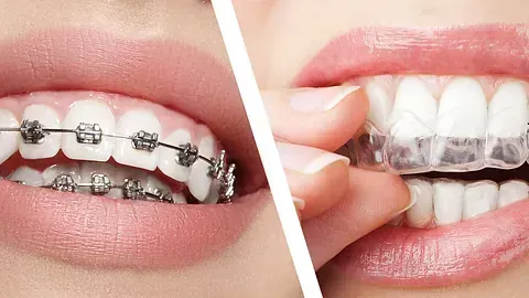 Una mujer con brackets en los dientes y una mujer con invisalign en los dientes.