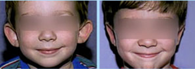 Chirurgie Esthetique Des Oreilles A Boulogne Billancourt 92