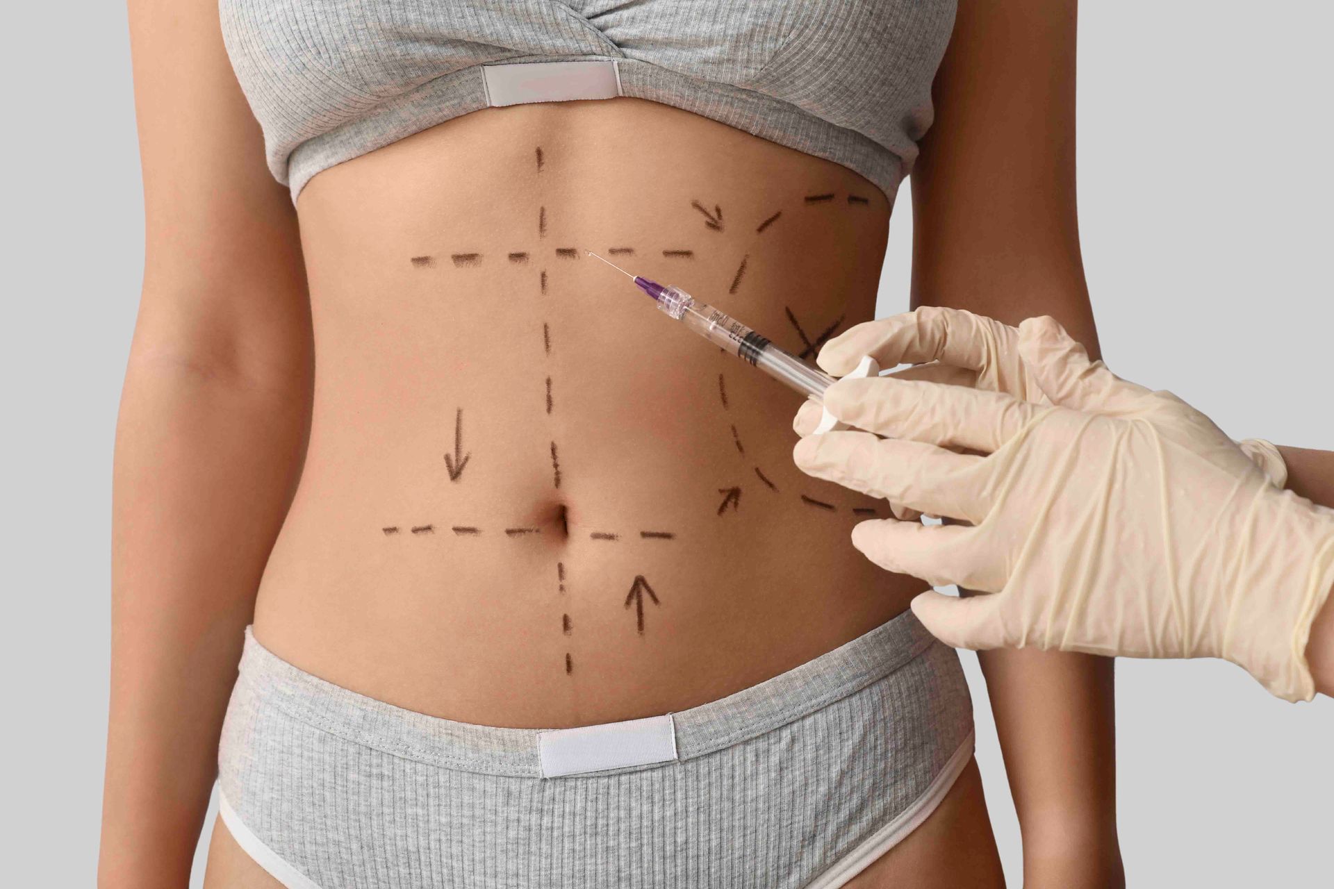 Mit behandschuhter Hand werden Linien auf dem Bauch eines Patienten zur Planung einer kosmetischen Operation markiert.
