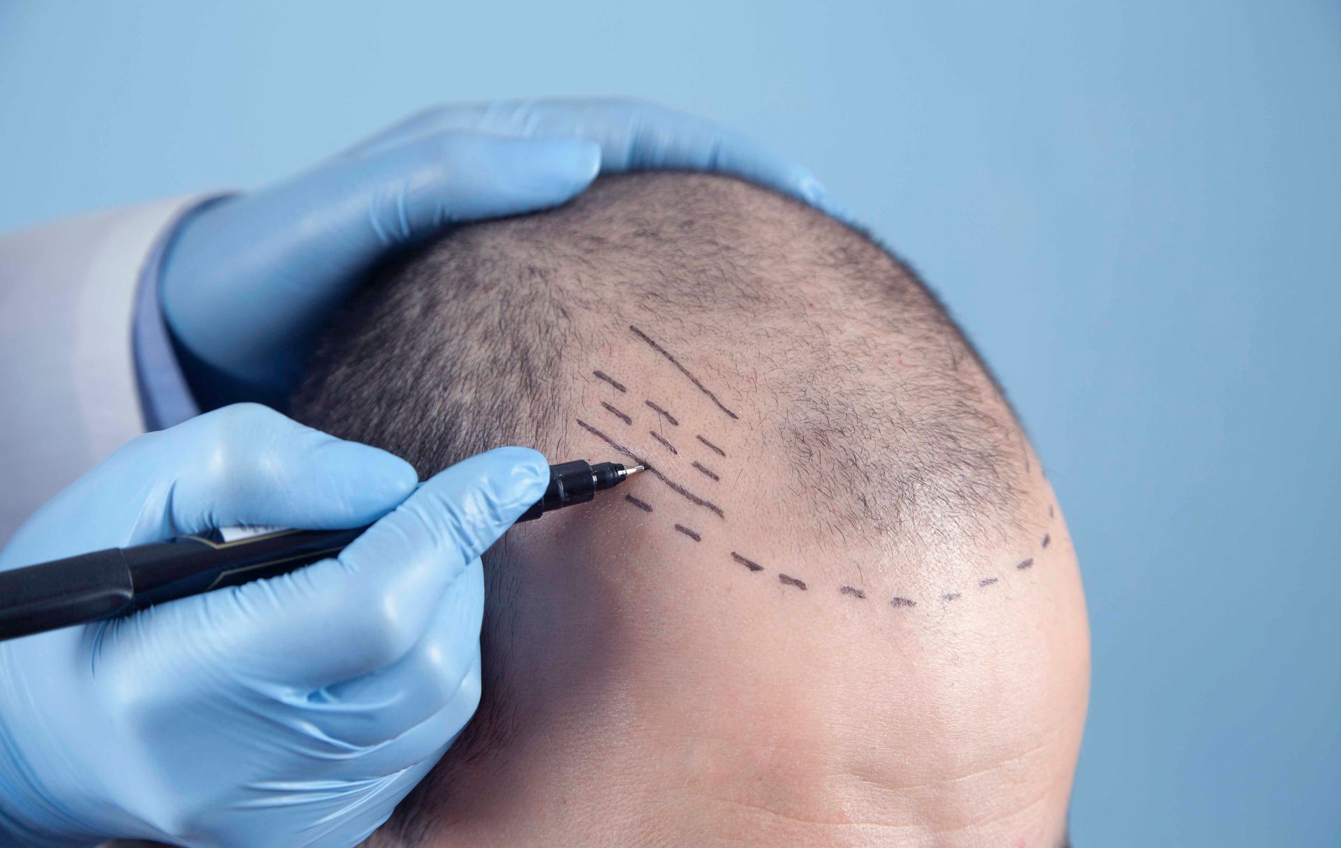 Behandschuhte Hände markieren mit einem Stift die kahle Kopfhaut für eine Haartransplantation.