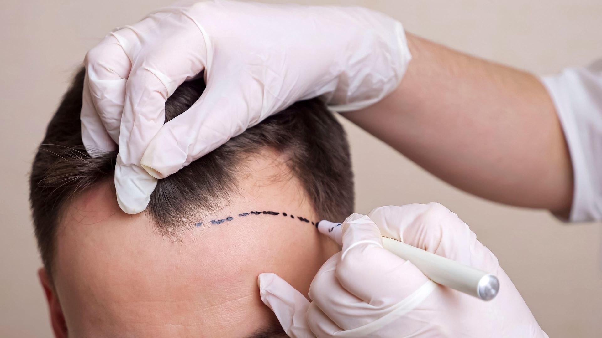 Behandschuhte Hände markieren mit einem Stift den Haaransatz auf der Stirn einer Person während eines kosmetischen Eingriffs.