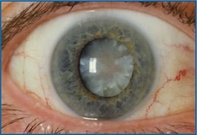 Auge mit einem trüben, weißen Katarakt in der Mitte der Iris.