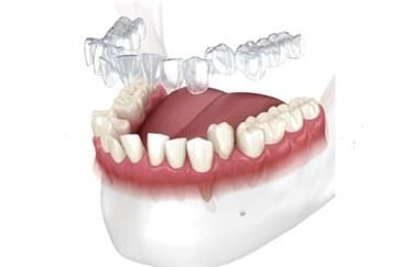 Invisalign Schiene Ein Modell der Zähne einer Person mit einer Zahnspange.