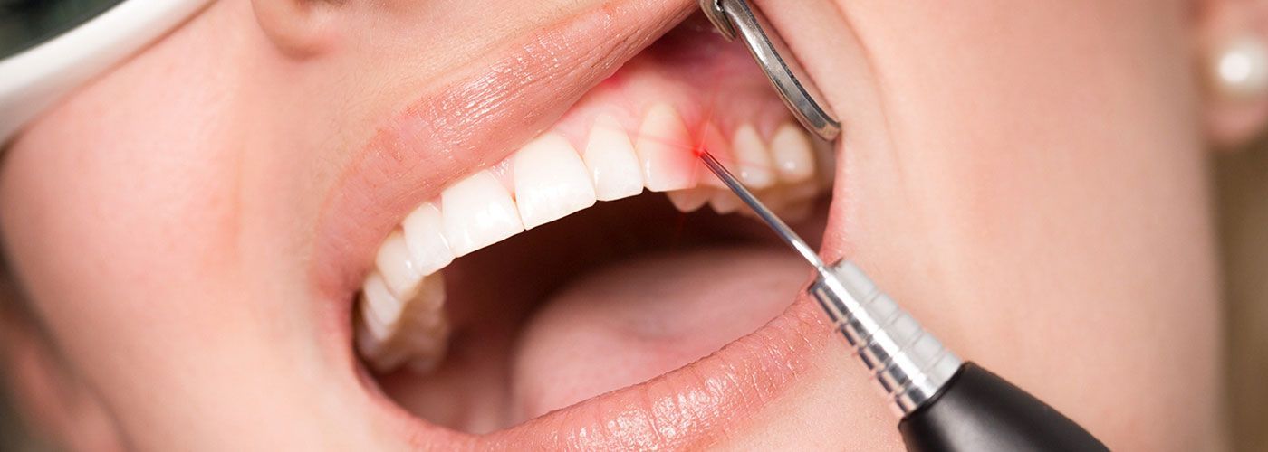 Laserbehandlung bei adentes Zahnärzte Eine Frau bekommt eine Laserbehandlung an den Zähnen.