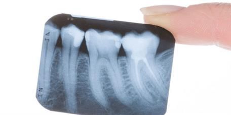 Eine Person hält ein Röntgenbild ihrer Zähne in der Hand.